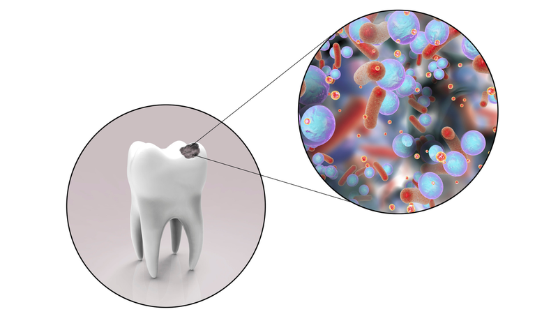 Vì sao răng chết tủy đổi màu? 3