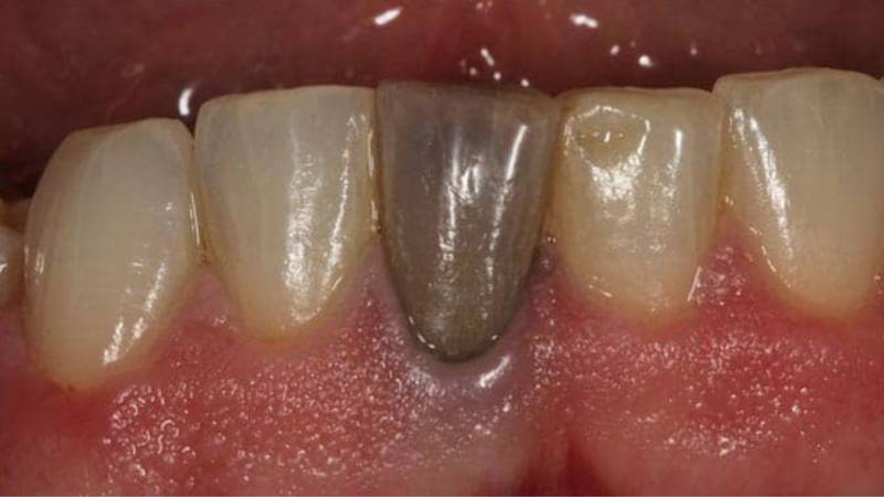 Vì sao răng chết tủy đổi màu? 2