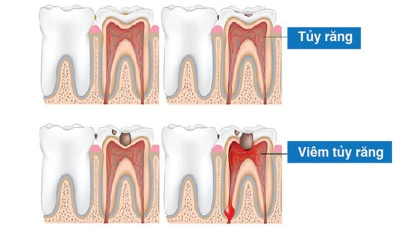 Vì sao răng chết tủy đổi màu? 1