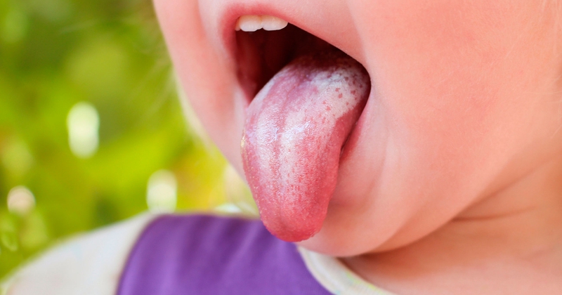 Vì sao trẻ bị nấm lưỡi thường xảy ra khi còn nhỏ?1