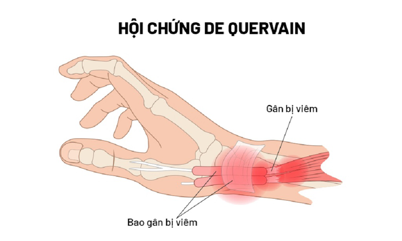 Viêm bao gân mỏm trâm quay cổ tay: Nguyên nhân, chẩn đoán và điều trị 1