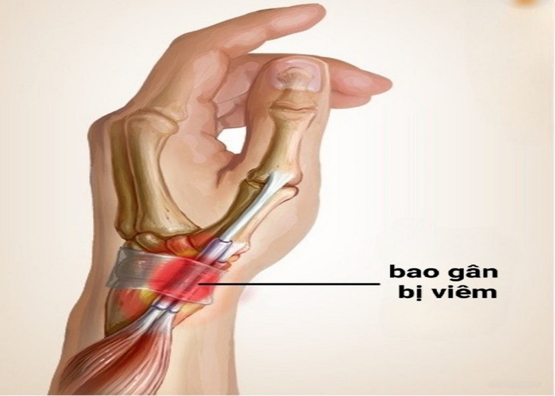 Viêm bao gân mỏm trâm quay cổ tay: Nguyên nhân, chẩn đoán và điều trị 2