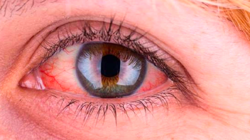 Viêm bờ trên mi mắt là gì? Nguyên nhân, triệu chứng và cách điều trị 4