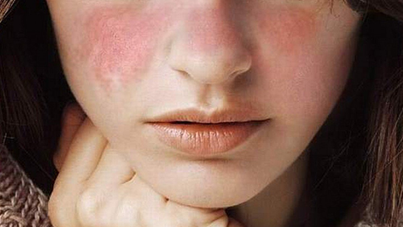 Viêm cầu thận Lupus là gì? Nguyên nhân, triệu chứng và cách điều trị 1