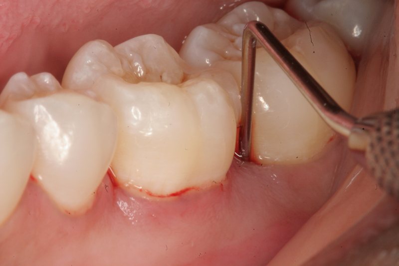 Viêm chân răng giả: Nguyên nhân, dấu hiệu và biến chứng 1