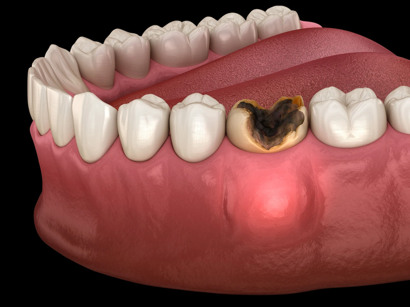 Viêm chân răng giả: Nguyên nhân, dấu hiệu và biến chứng 3