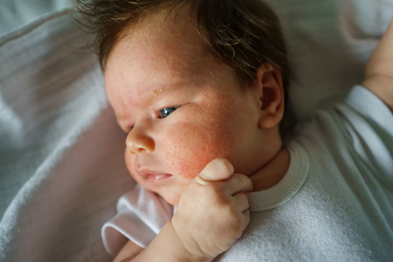 Viêm da cơ địa ở trẻ sơ sinh có đáng lo không và điều trị như thế nào? 1