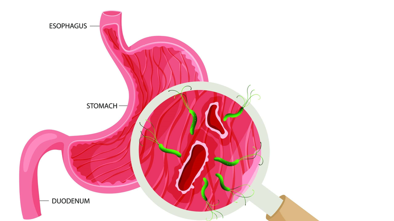 Viêm dạ dày tá tràng: Bệnh thường gặp hiện nay 2.jpg