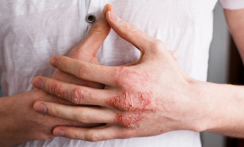 Viêm da tiếp xúc có lây không? Phương pháp điều trị viêm da tiếp xúc 2