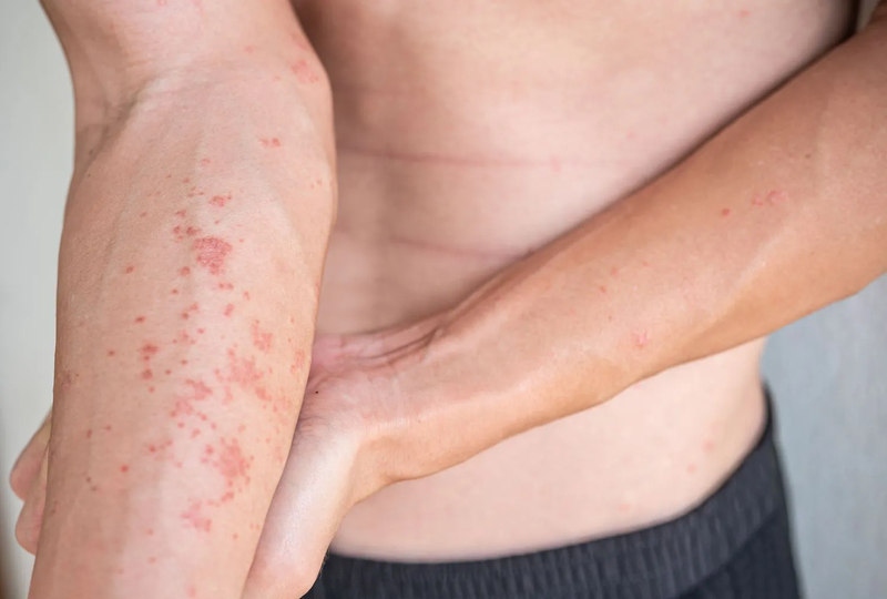 Viêm da tiếp xúc có lây không? Phương pháp điều trị viêm da tiếp xúc 4