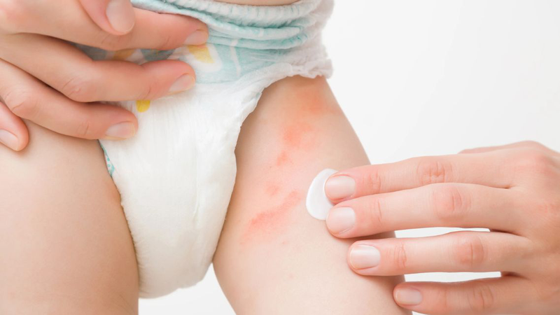 Tìm hiểu chi tiết về bệnh viêm da tiếp xúc ở trẻ 1