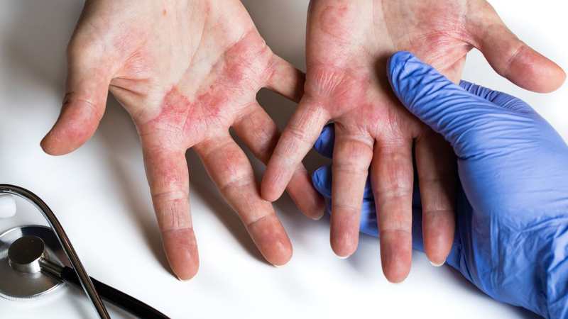 Tìm hiểu chi tiết về bệnh viêm da tiếp xúc ở trẻ 4