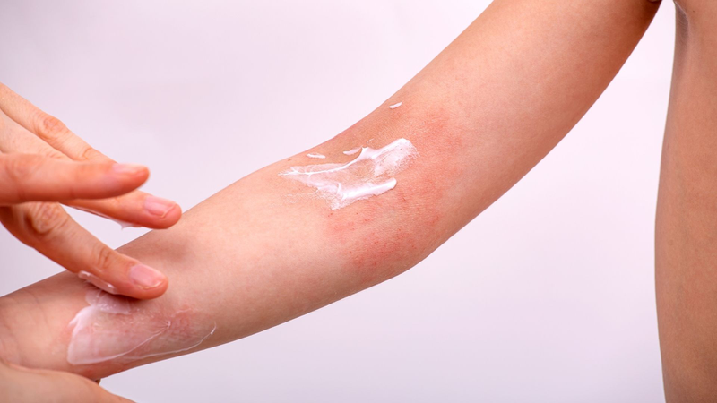 Viêm da tiếp xúc và viêm da cơ địa: Cách phân biệt và hướng xử trí hiệu quả 5