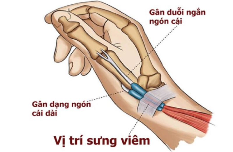 Viêm gân duỗi ngón cái: Nguyên nhân, triệu chứng, chẩn đoán và điều trị 3
