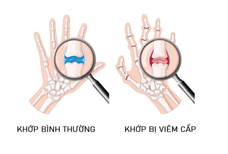 viem-khop-cap-tinh-1.jpg