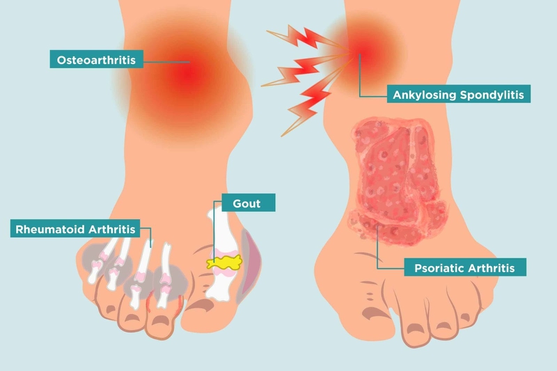 Viêm khớp ngón chân là gì? Những vấn đề cần biết về bệnh lý viêm khớp ngón chân 5
