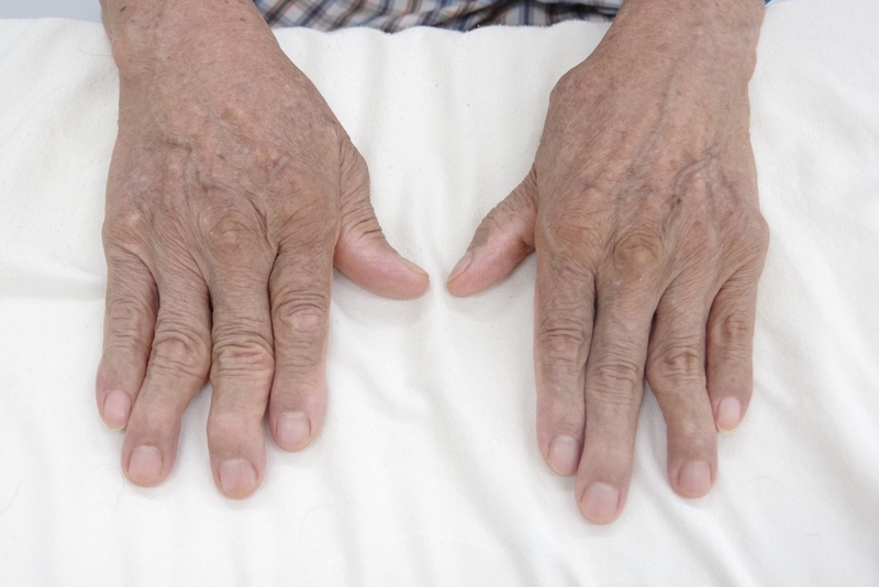 Viêm khớp ngón tay là gì? Những vấn đề cần biết về bệnh lý viêm khớp ngón tay 4