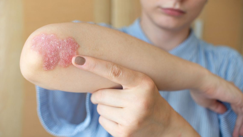 Rất nhiều bệnh nhân muốn biết viêm khớp vảy nến có chữa được không