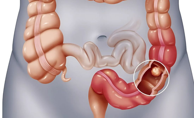 Viêm loét đại tràng bên trái: Nguyên nhân, triệu chứng, cách điều trị