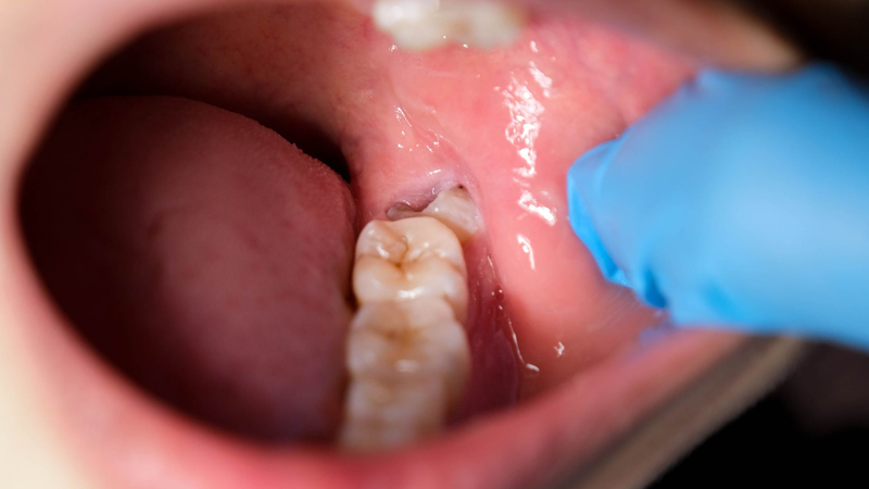 Viêm lợi trùm răng khôn là tình trạng nhiễm trùng phần lợi phủ quanh răng khôn