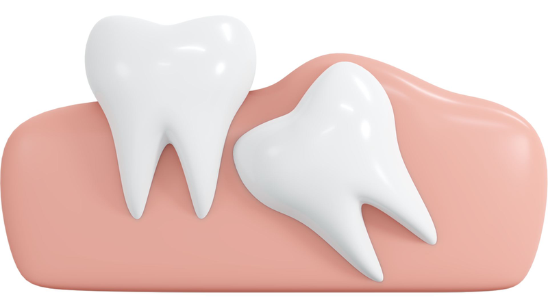 Các triệu chứng đặc trưng giúp nhận biết viêm lợi trùm răng khôn