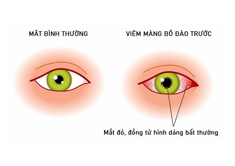 Viêm màng bồ đào trước: Nguyên nhân, triệu chứng và cách điều trị 1