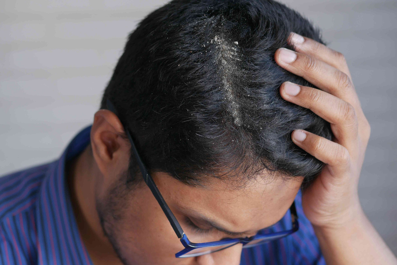 Viêm nang lông da đầu​ do đâu và cách điều trị? - 2