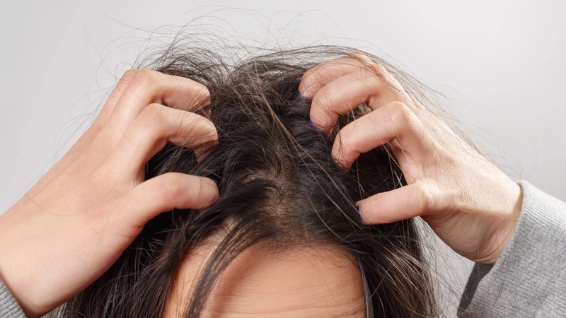 Viêm nang lông da đầu​ do đâu và cách điều trị? - 3