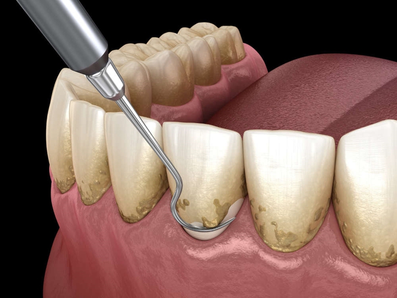 Viêm nha chu bao lâu thì khỏi? Cách chữa viêm nha chu nhanh khỏi 2