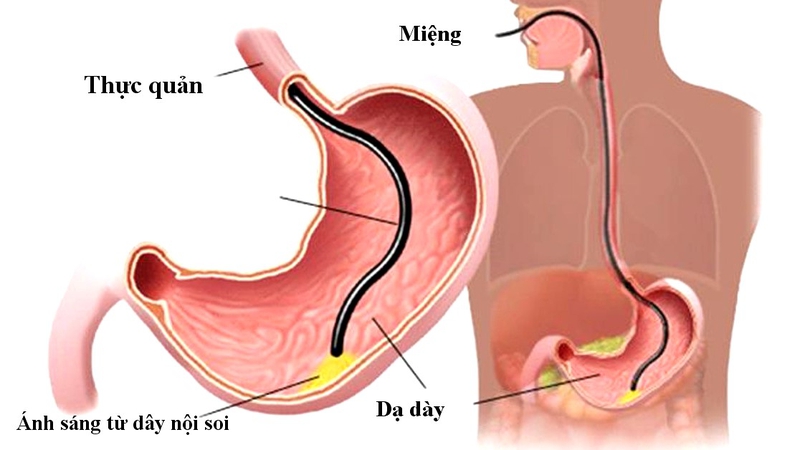 Viêm niêm mạc dạ dày và những điều cần biết 3