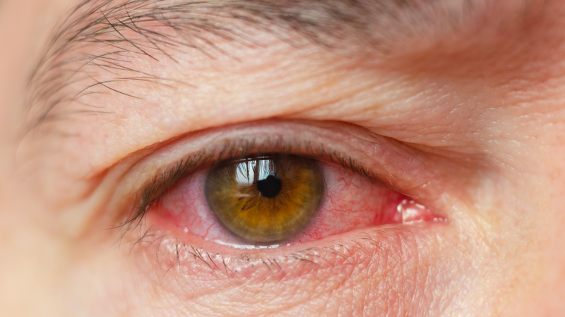 Viêm nội nhãn và viêm màng bồ đào - Hai bệnh viêm mắt không thể chủ quan 1