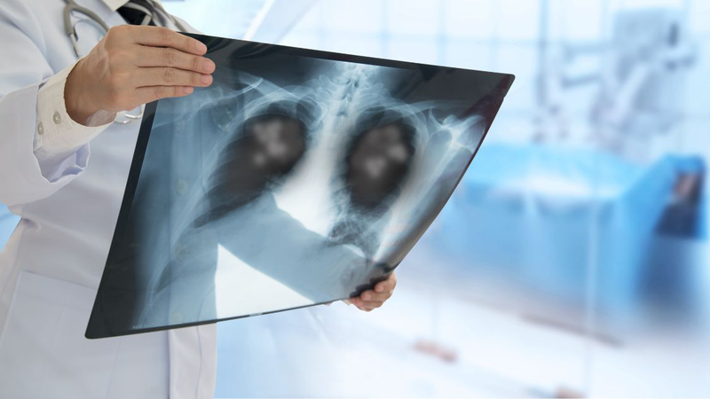 Viêm phổi do cúm A: Nguyên nhân, triệu chứng, cách điều trị 1