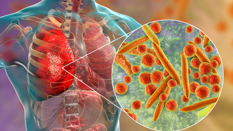 Viêm phổi do virus Mycoplasma ở trẻ em gây ra biểu hiện gì? 1