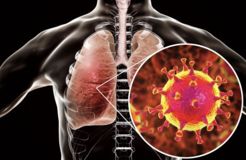 Viêm phổi Mycoplasma ở người lớn: Thông tin cần nắm 3