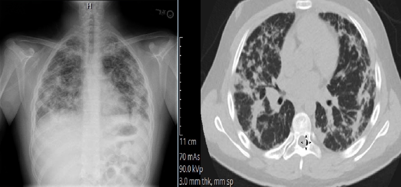 Viêm phổi tăng bạch cầu ái toan là gì? Những vấn đề cần biết về bệnh viêm phổi tăng bạch cầu ái toan 6
