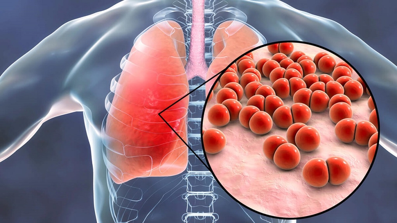 Viêm phổi tăng cảm là gì? Triệu chứng nhận biết và cách điều trị bệnh hiệu quả 3