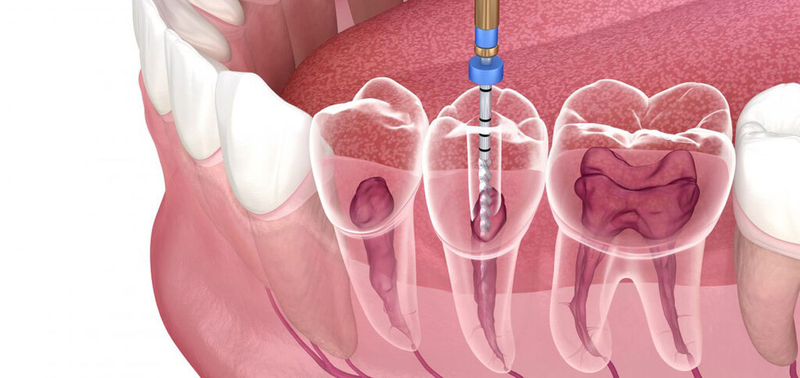 Viêm quanh răng là gì? Nguyên nhân gây bệnh và biện pháp phòng ngừa 7