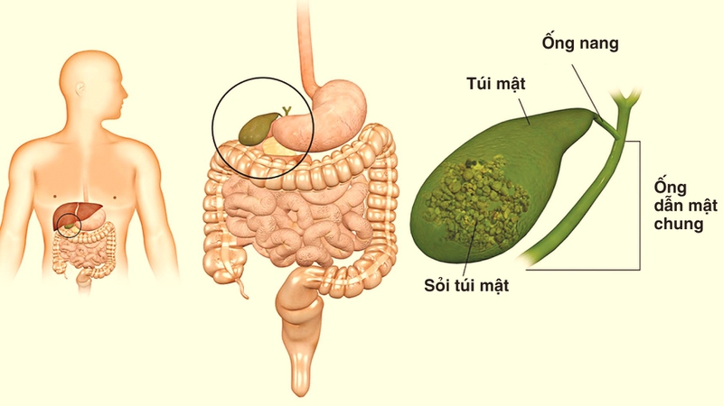 Viêm túi mật cấp: Triệu chứng và phương pháp điều trị 2.jpg