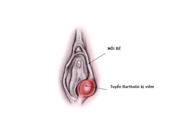 Chi phí mổ viêm tuyến bartholin hết bao nhiêu 1