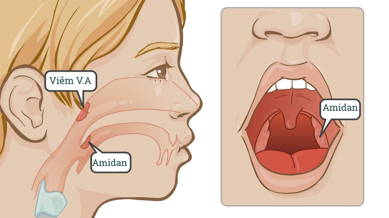 Triệu chứng và cách điều trị viêm VA mãn tính ở trẻ 1