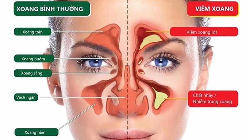 Viêm xoang có chữa được không? Cách điều trị và phòng tránh