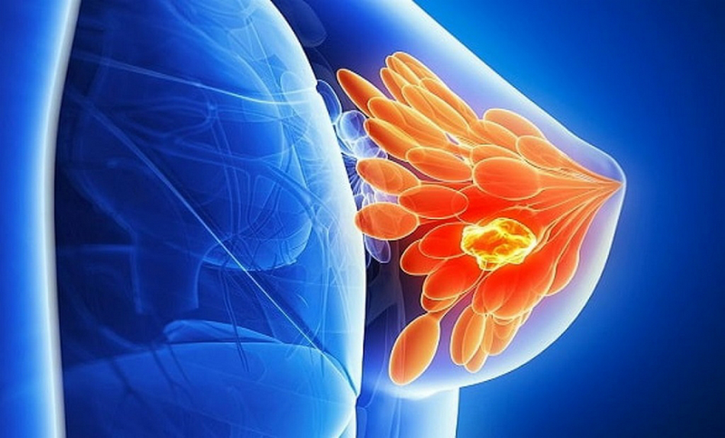 Xạ trị sống được bao lâu và cần biết những gì về xạ trị ung thư? 2