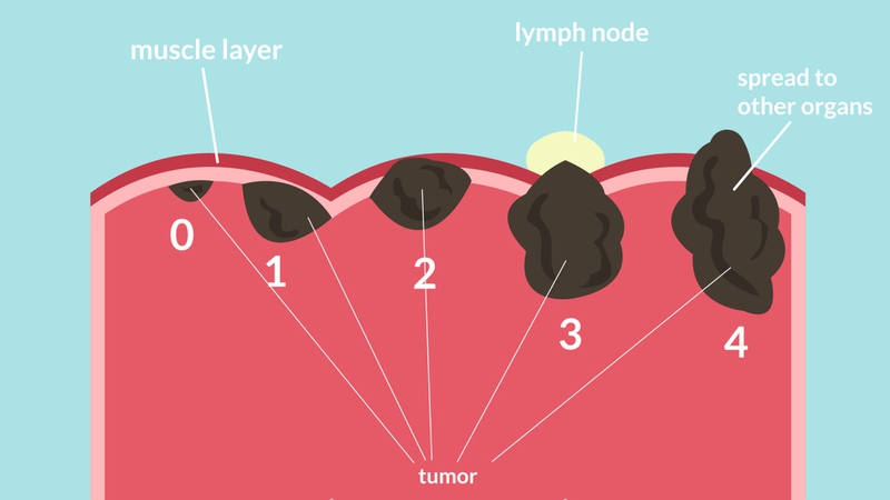 Ý nghĩa xác định giai đoạn của bệnh ung thư 4