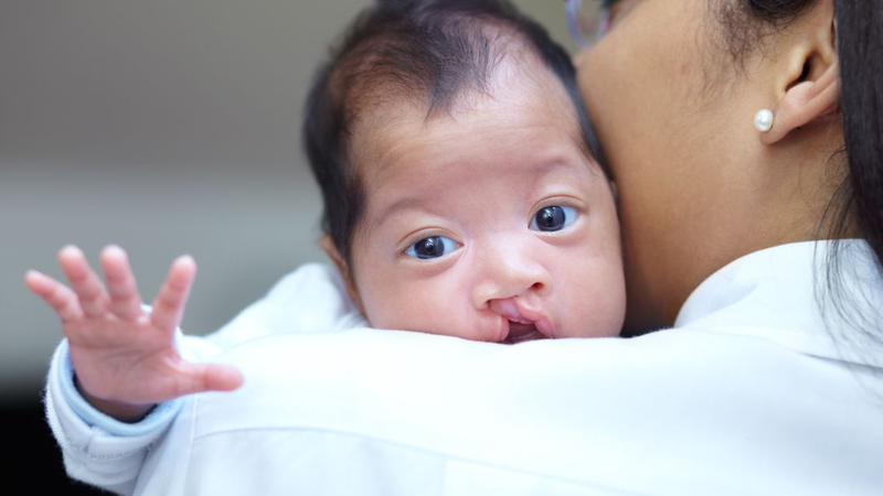 Xét nghiệm NIPT có phát hiện hở hàm ếch không 1