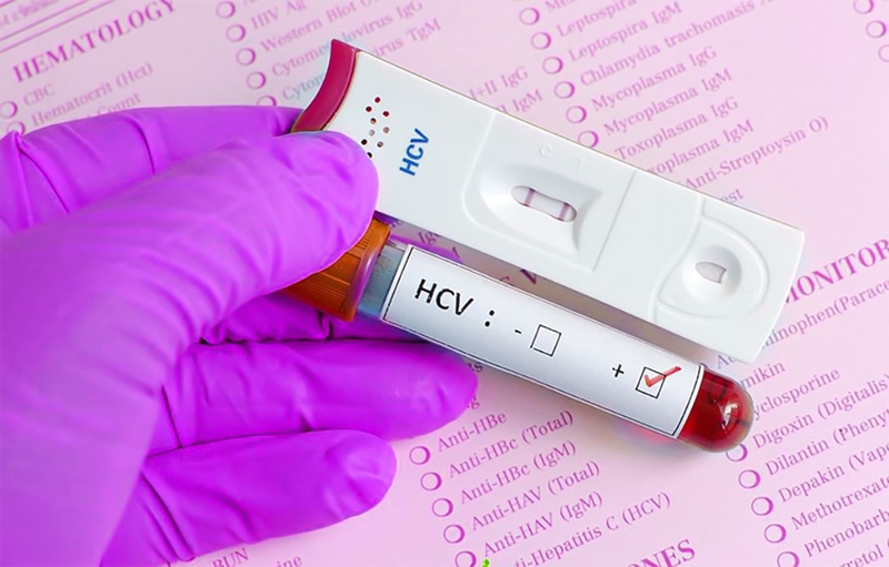 Xét nghiệm Anti HCV tìm kháng thể chống virus viêm gan C 2