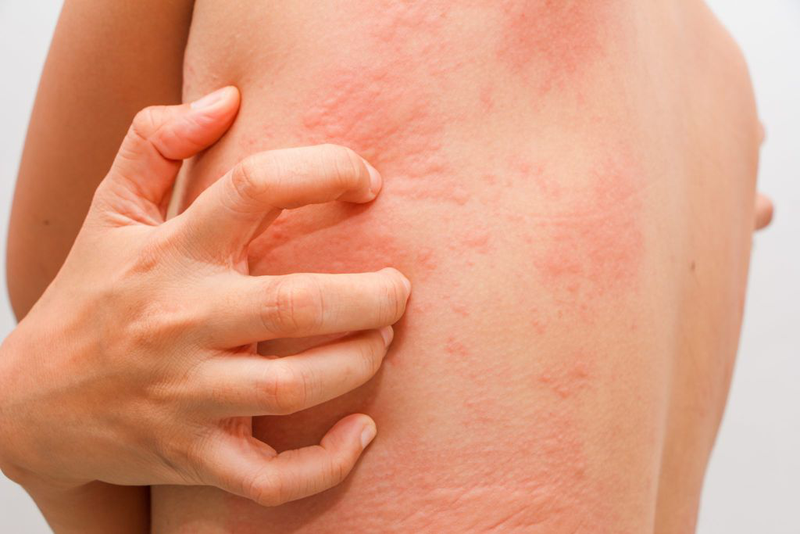 Xét nghiệm dị nguyên ige tổng thể đặc hiệu là gì? Ý nghĩa lâm sàng của xét nghiệm 2