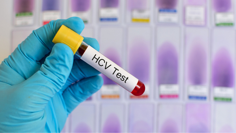 Xét nghiệm định lượng virus viêm gan C là gì? Cần làm gì nếu dương tính? 2