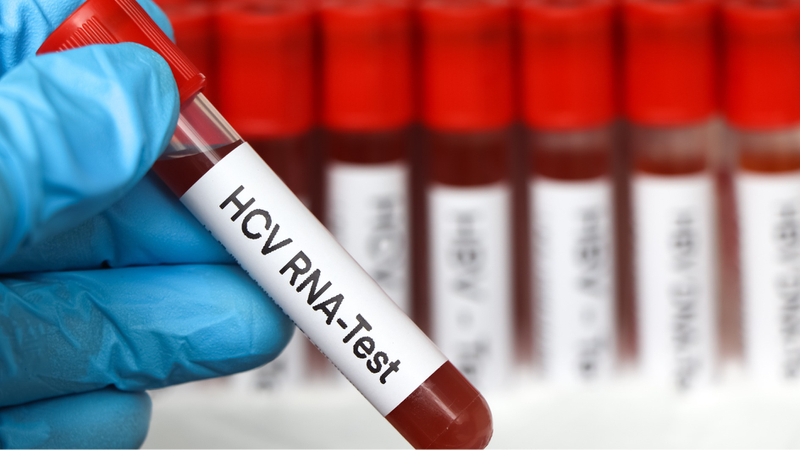 Xét nghiệm định lượng virus viêm gan C là gì? Cần làm gì nếu dương tính? 4