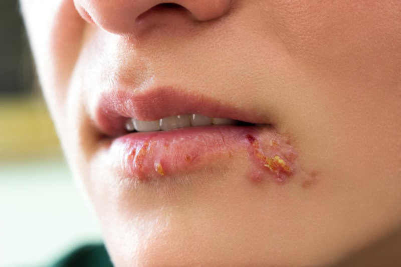 Xét nghiệm HSV – Phương pháp phát hiện bệnh Herpes hiệu quả 2