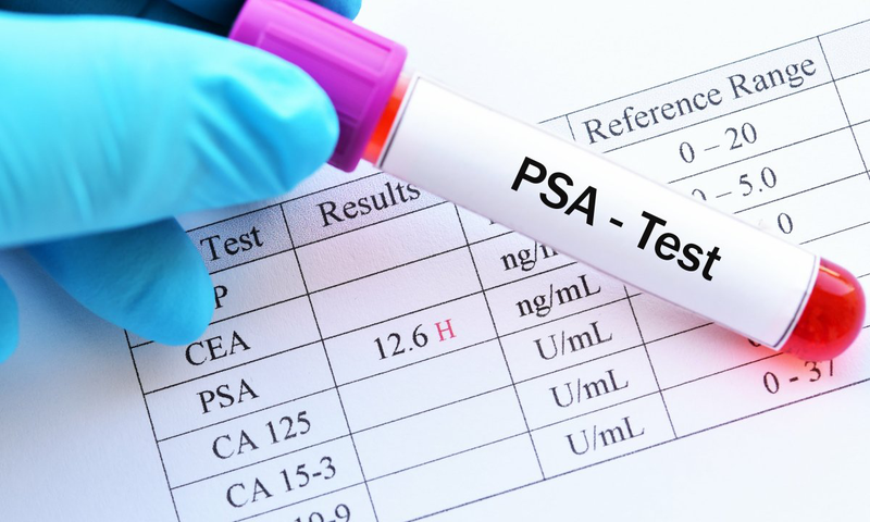 Xét nghiệm PSA là gì? Đối tượng nào cần xét nghiệm PSA? 1